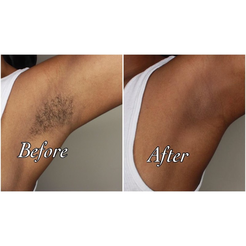 Armpit Waxing Armpit Waxing