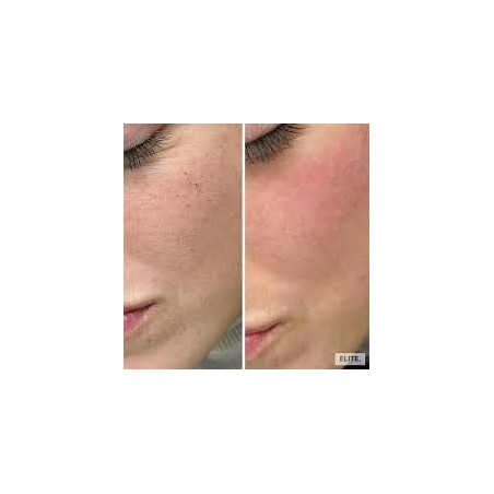 Dermabrassion Facials/Face lifting Facials
