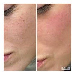 Dermabrassion Facials