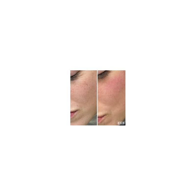 Dermabrassion Facials Dermabrassion Facials
