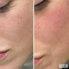 Dermabrassion Facials Dermabrassion Facials